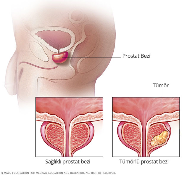 prostat-kanseri-prof-dr-b-lent-nal