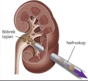 PCNL - Böbrek Taşı Tedavisi - Prof. Dr. Bülent Önal