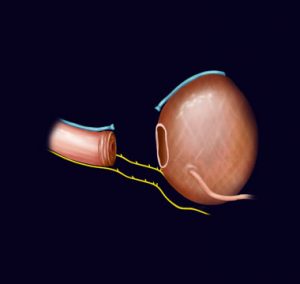 Radikal Prostatektomi - Prof. Dr. Bülent Önal