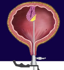 TUR-T - Prof. Dr. Bülent Önal